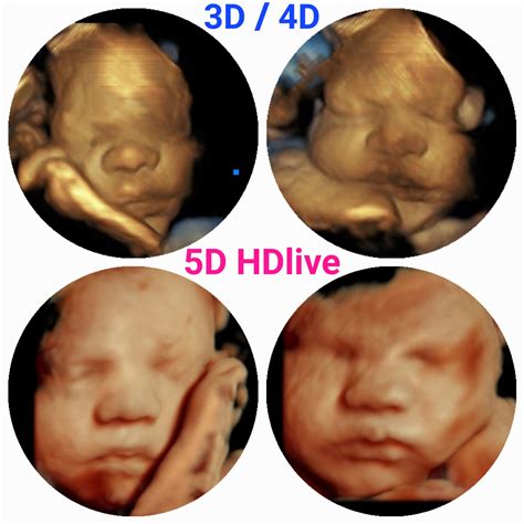 How To Get The Best 3d Ultrasound Pictures 3d Baby Boutique