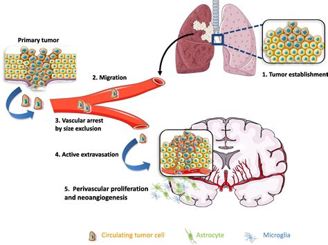 Non Small Cell Lung Cancer Brain Metastases And The Immune System From