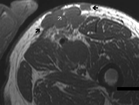 Mri Of Merkel Cell Carcinoma Histologic Correlation And Review Of The