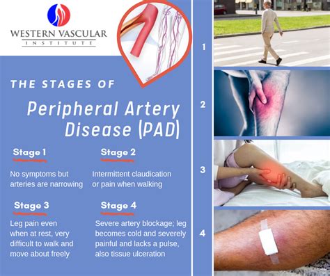 Stages Of Peripheral Artery Diseasd Vascular Peripheral Artery
