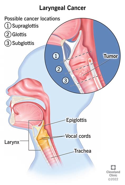 Laryngeal Cancer Symptoms Causes And Treatment