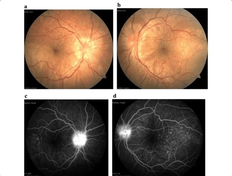 Images Of The Right And Left Eyes Of Patient 2 At Diagnosis Of Vkh