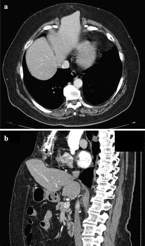 Abdominal Computed Tomography Showing Left Hepatic Lobe Herniation