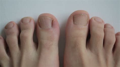 Young Healthy Feet Get Old And Sick With Toenails Fungal Infection