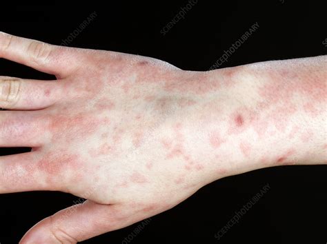 Epstein Barr Virus Infection Stock Image C0259598 Science Photo