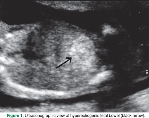 Figure 1 From Mid Trimester Hyperechogenic Bowel In A Fetus Of Turkish Origin Carrying A Rarely