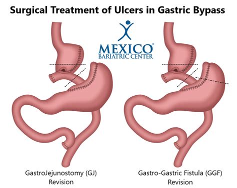 Signs And Symptoms Of Ulcers After Gastric Bypass Mexico Bariatric