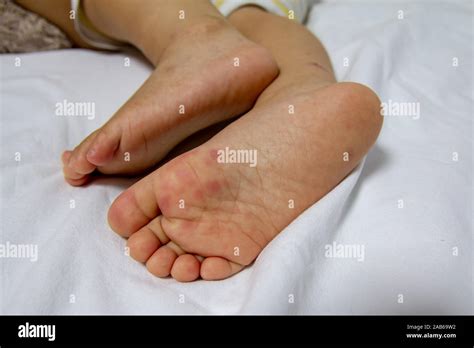 Allergic Rash Skin Of Babys Right Foot Hand Foot And Mouth Disease
