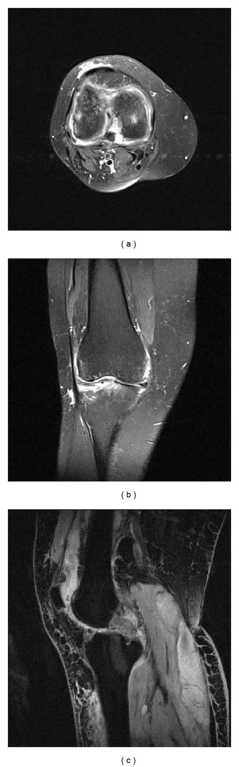 Postoperative T2 Weighted Mr Images Of The Right Knee Revealing