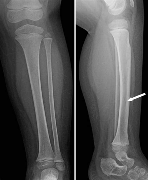 Whole Leg Radiograph Of The Lower Extremity Revealed A Open I