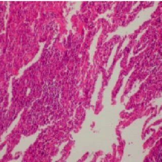 Neumonía Intersticial Descamativa Presencia de macrófagos pardos en la Download Scientific
