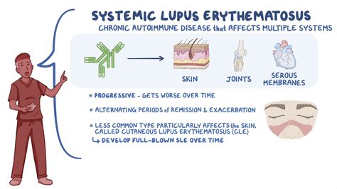 Systemic Lupus Erythematosus Sle Nursing Osmosis Video Library