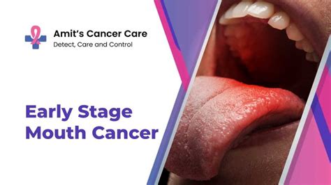 The Early Stage Of Cheek Mouth Cancer Symptoms And Treatments