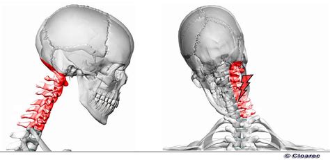 Torticollis, also known as wry neck, is a dystonic condition defined by an abnormal, asymmetrical head or neck position, which may be due to a variety of causes. oedeme | AXEL CLOAREC OSTEOPATHE BIOMECANICIEN