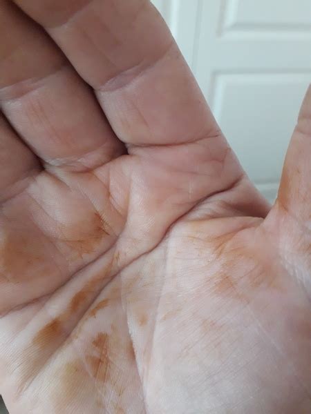 What Are These Orange Stains That Have Appeared On My Hands Overnight