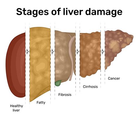 Understanding Fatty Liver Disease Kmh Health Blog