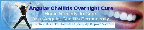 Angular Cheilitis Natural Cure Angular Cheilitis Treatment Natural