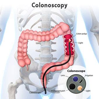 You must not eat any solid food and may only eat a clear liquid diet. Colonoscopy Preparation, Risks, Age, Recovery, Diet & Sedation