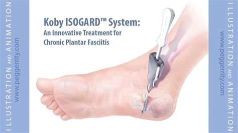 Plantar Fasciitis Surgical Treatment Animation By Certified Medical