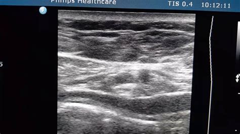 Lumbar Hernia Ultrasound