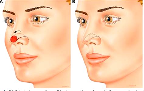 Figure From Transposition Flaps In Nasal Reconstruction Semantic