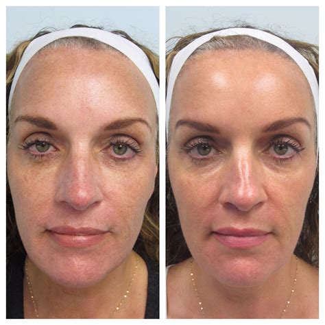 Erasing Your Sun Damage The New Fraxel Dual Treatment West Institute