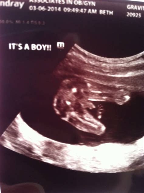 Pin By Stephanie Gravitt On First Pregnancy Gender Reveal Ultrasound