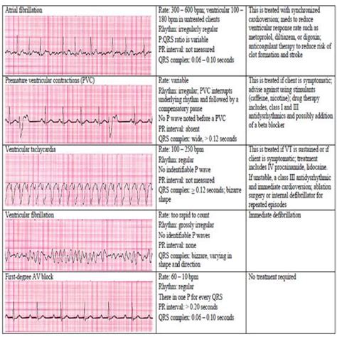 13 Cardiac Rhythm And Dysrhythmias Cheat Sheet Any Nurse Must Know For The Exam In 2021