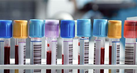 We did not find results for: These 3 Lab Tests Will Help You Live Longer, Says "Wheat ...