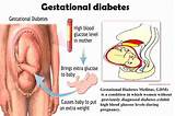 Gestational Diabetes Treatment Insulin Photos