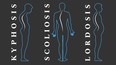 Premium Vector Diseases Of The Spine Scoliosis Lordosis Kyphosis