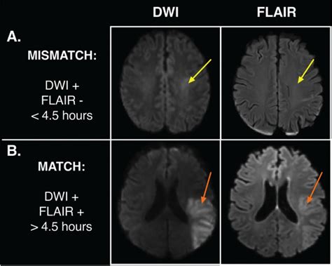 Timing The Ischemic Stroke By Multiparametric Quantitative Magnetic