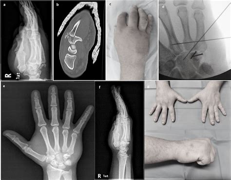 A Oblique 30o X Ray Of The Injured Wrist Showing Dislocation Of The