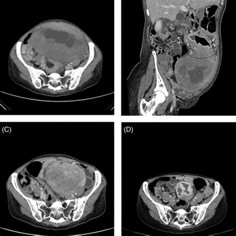 Case 1 Ab Contrast‐enhanced Ct Scan At The Onset Of Severe