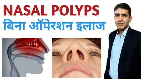 Nasal Polyps Symptomscauses And Treatment नाक में मांस बढ़ना Nasal