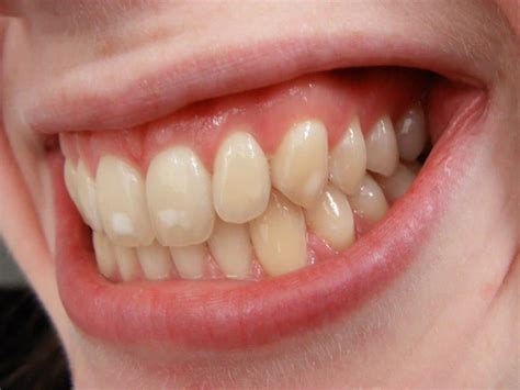 Do Orthodontic Braces Cause White Spots On Teeth