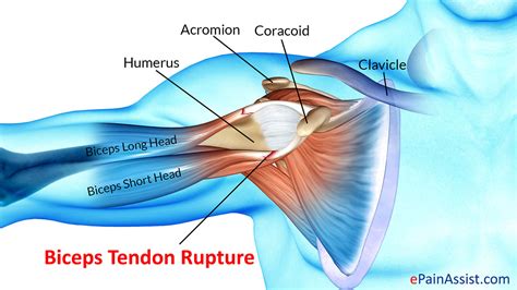 12 photos of the muscles and tendons of the leg. Biceps Tendon Rupture: Treatment, Exercise, Types, Causes