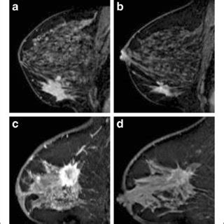 Pdf Mri Based Response Patterns During Neoadjuvant Chemotherapy Can Predict Pathological