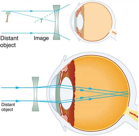 But, a lot of people still use the previous solution for presbyopia. الانفلونزا العنكبوت يطبخ for short sightedness which lens ...