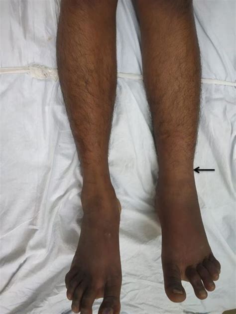 Lymphoedema Praecox In A Young Woman A Rare Disease Bmj Case Reports