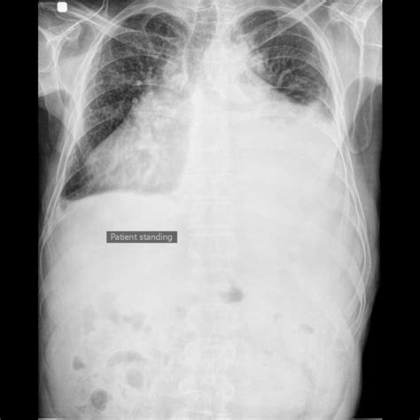 Pleural effusion is a condition in which excess fluid builds around the lung. Cardiomegaly with bilateral pleural effusion | Radiology ...
