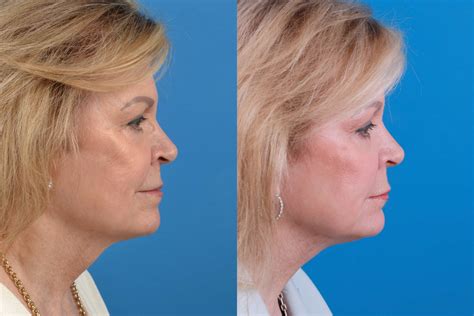 Patient 122406582 Profile Neck Lift Before And After Photos Clevens
