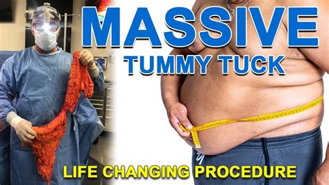 Massive Tummy Tuck Surgery Youtube