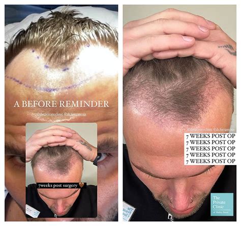 Hair Growth After Hair Transplant After Follicular Transfer Fue Hair