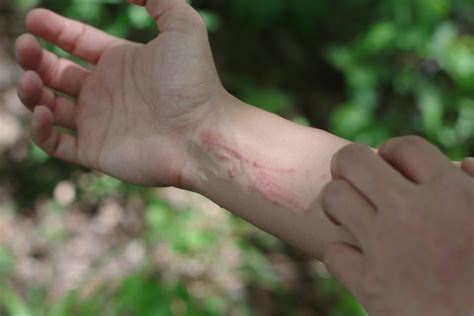 How To Treat A Poison Ivy Rash At Home Amory Urgent Care