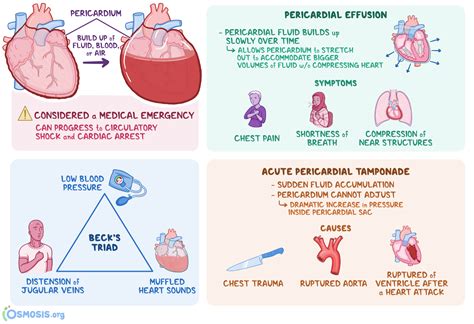 Infections, heart attacks, trauma, cancer, and autoimmune disorders can all cause pericarditis. Pericardial Tamponade: What Is It, Causes, Pericardial Effusion, Signs, Diagnosis, Treatment ...