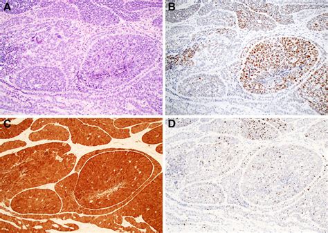 The Subset Of Basaloid Scc That Are Hpv Positive Can Also Mimic