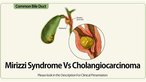 Mirizzi Syndrome Vs Cholangiocarcinoma YouTube