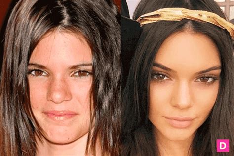 Kendal Jenner Before And After Plastic Surgery