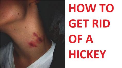 How To Get Rid Of A Hickey In One Night How To Hide A Hickey Youtube